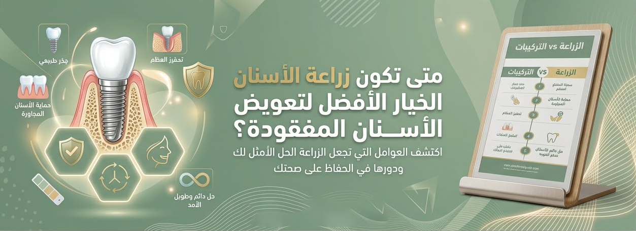 متى تكون زراعة الأسنان الخيار الأفضل لتعويض الأسنان المفقودة؟