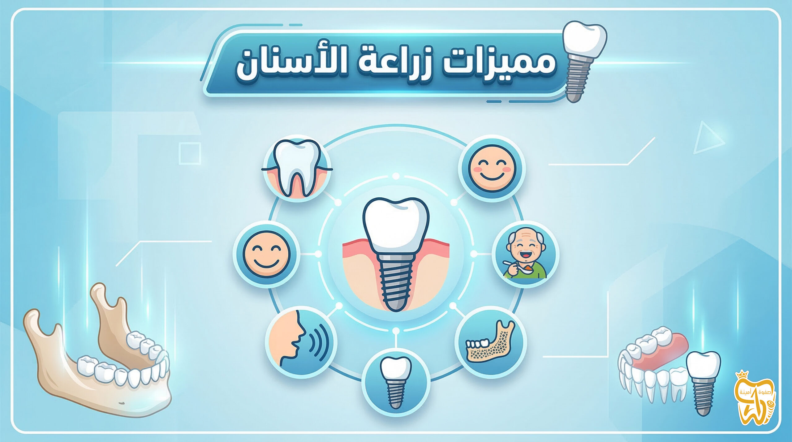 مميزات زراعة الأسنان